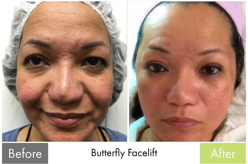 Before & After