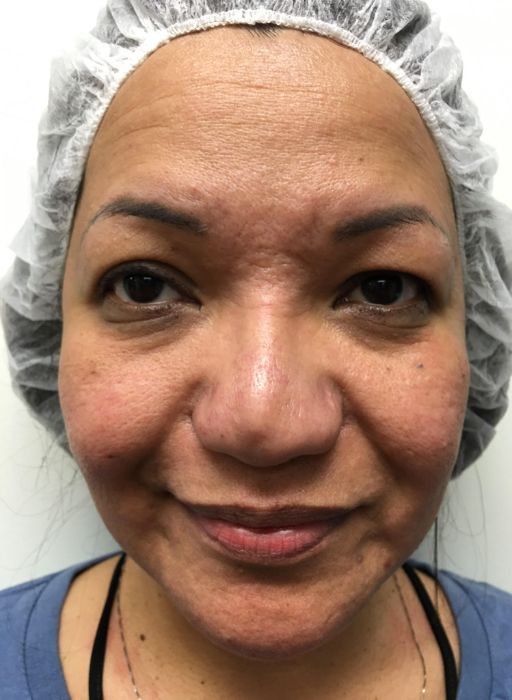 Acne Scar Removal