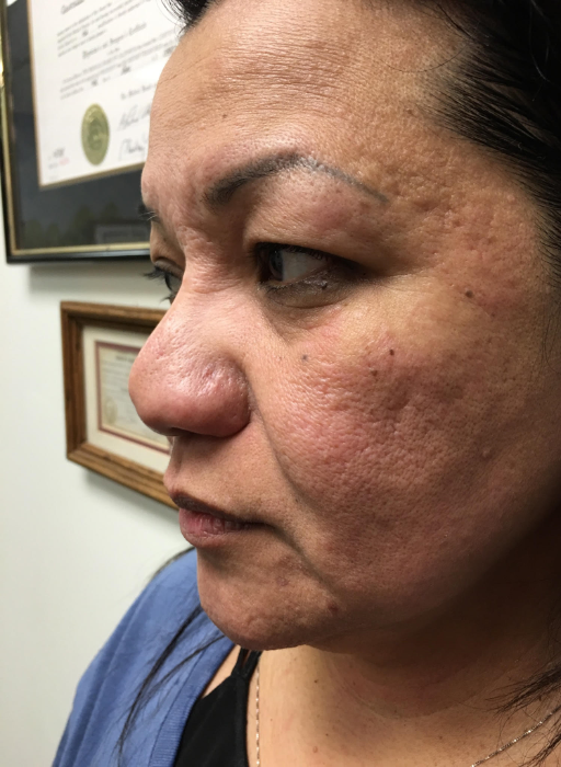 Acne Scar Removal