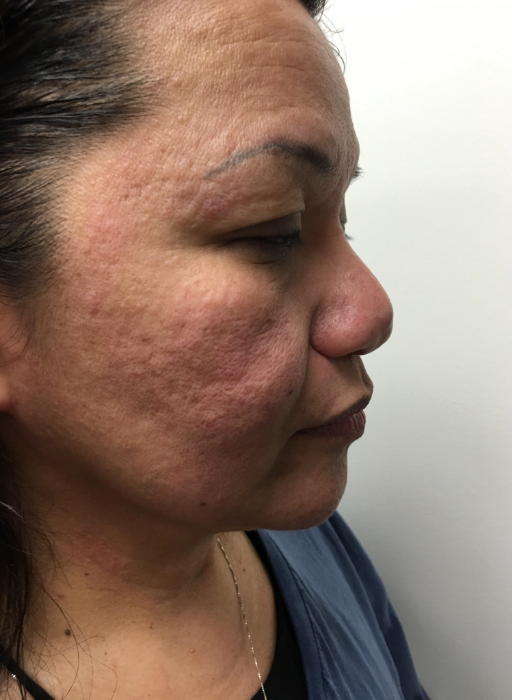 Acne Scar Removal