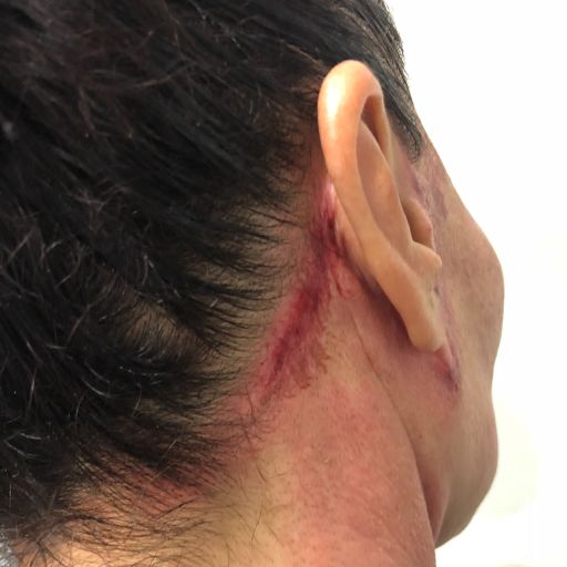 DURING HEALING