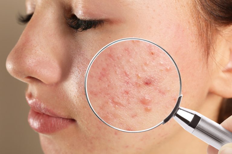 Battling Acne: Your Guide to Effective Acne Treatments