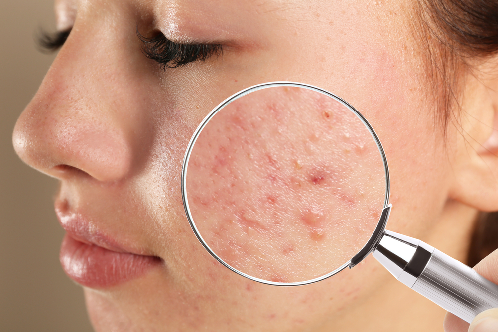 Battling Acne: Your Guide to Effective Acne Treatments