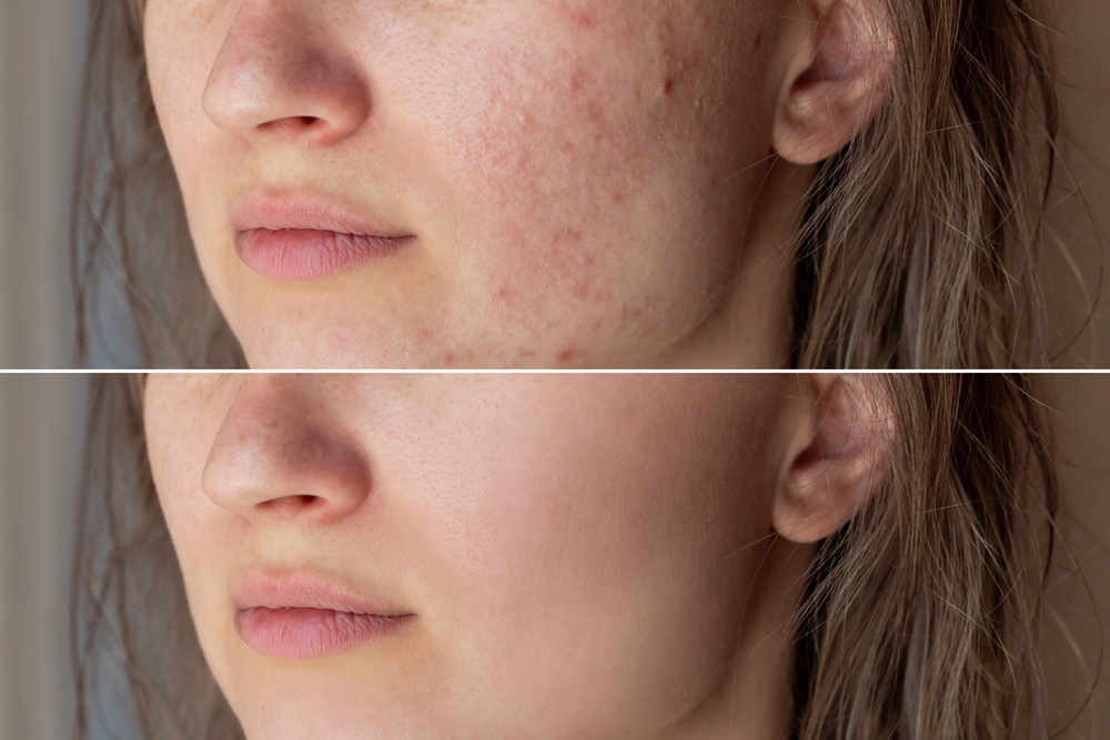 Acne Scar Removal in Huntington Beach