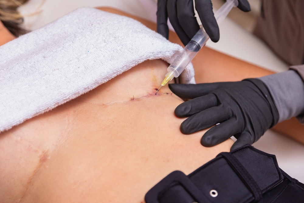 Reclaim Your Confidence with Scar Reduction Treatments