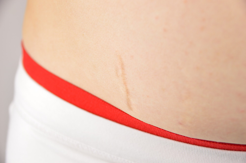 Liposuction Scars in Huntington Beach