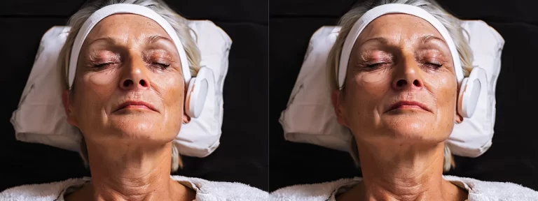 a radiant woman receiving a non-surgical facelift treatment, her skin glowing with a youthful appearance.